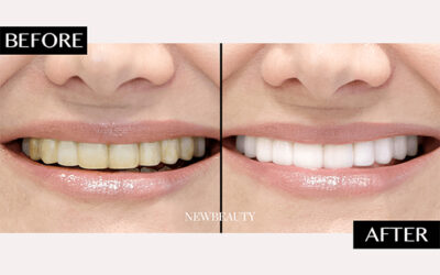 Can Healthy Teeth Be Yellow? 